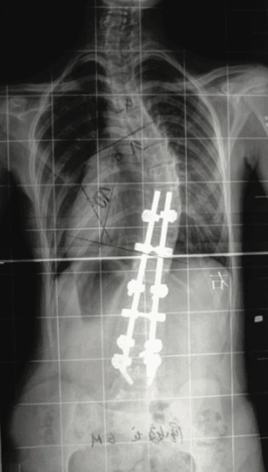 chirurgie scoliose